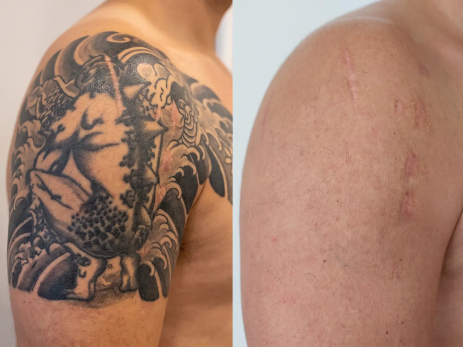 Before and after comparison of a tattoo faded through a proper multi-session laser removal plan