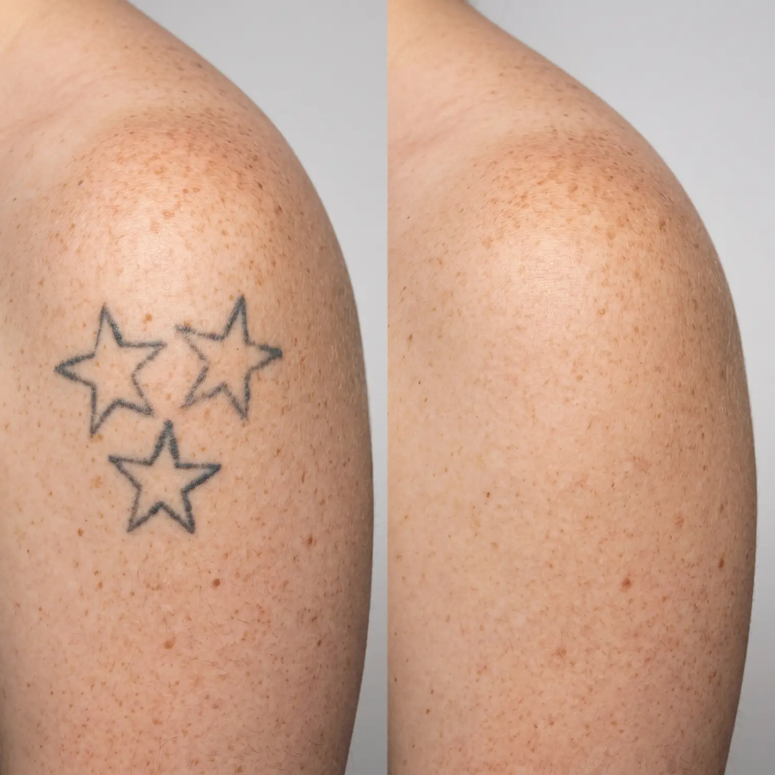 Before and after comparison showing a tattoo faded through partial laser removal treatment