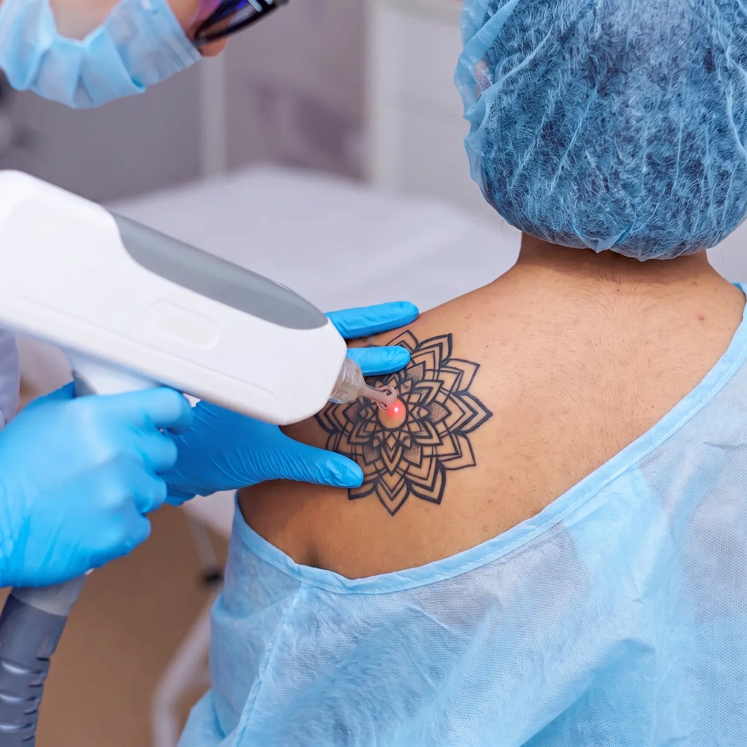 Laser tattoo removal treatment in progress, targeted fading session on a shoulder tattoo